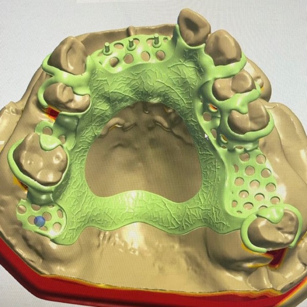 Dental Digital Metal Frame Design